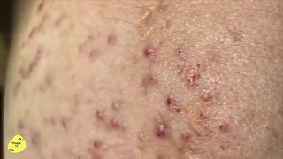137 Nặn mụn ẩn siêu đã part 2 | Squeeze super hidden acne