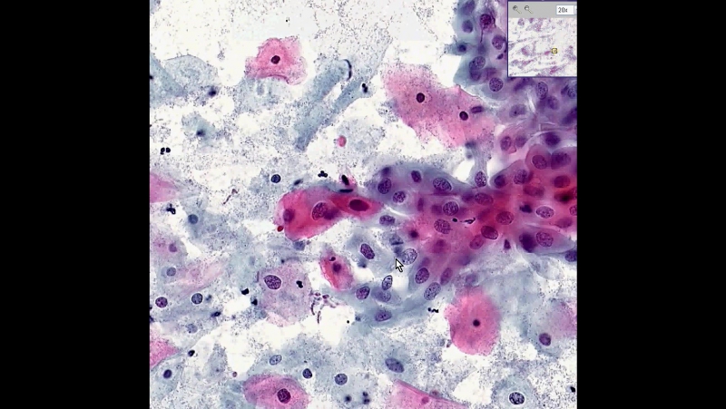 Cervix High grade squamous intraepithelial lesion ( HSIL), Pap